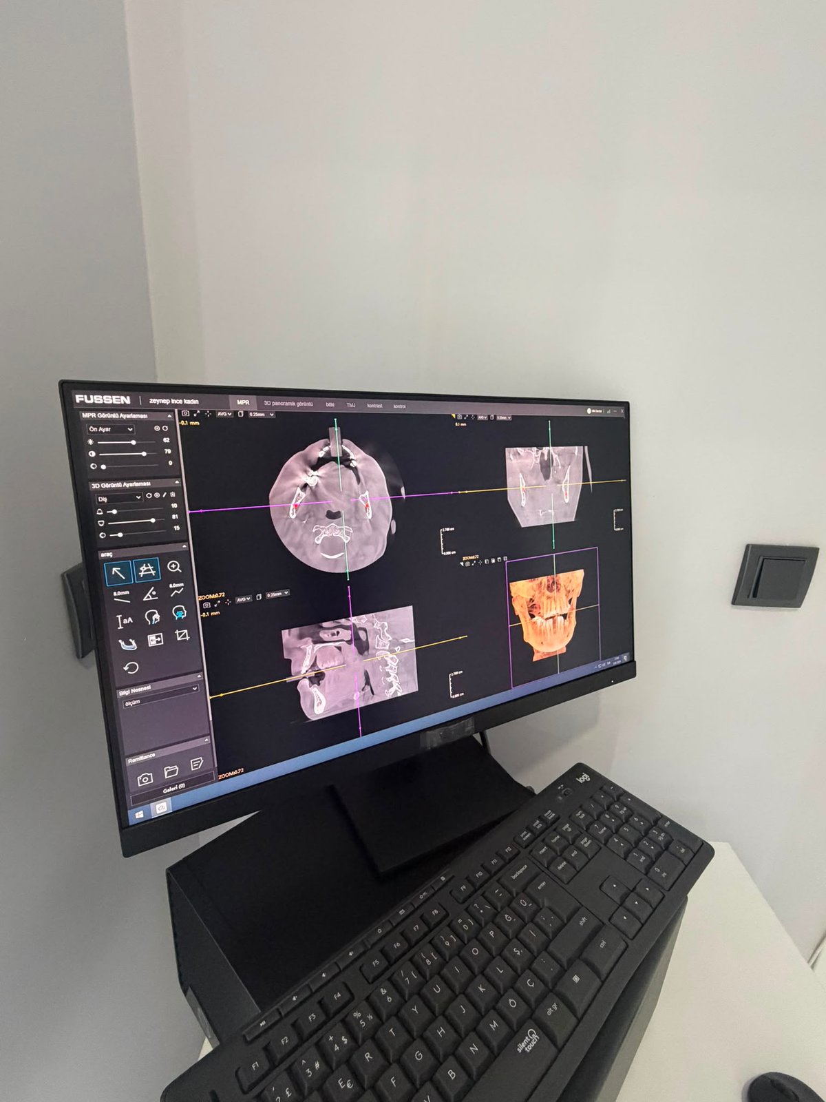 3D dijital tomografi değerlendirmesi